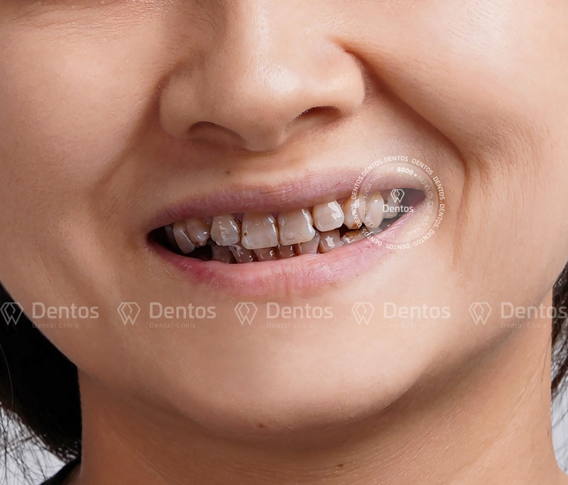 Răng nhiễm Tetracycline: Nguyên nhân do đâu và khắc phục như thế nào?