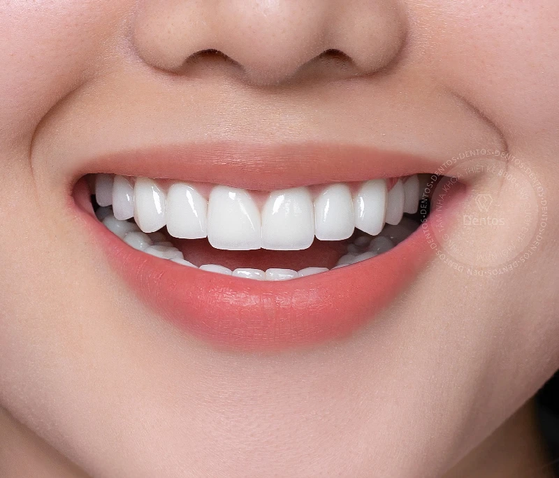 Sau khi bọc răng sứ nên làm gì để răng sứ bền đẹp lâu dài?