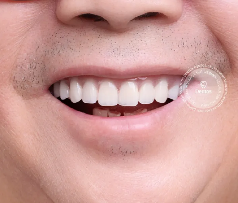 Trồng răng sứ vĩnh viễn: Nên làm cầu răng sứ hay cấy ghép Implant?