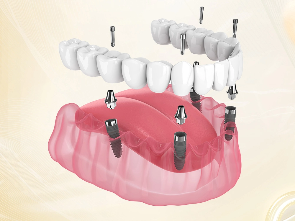 Implant Toàn Hàm All-on-4/All-on-6