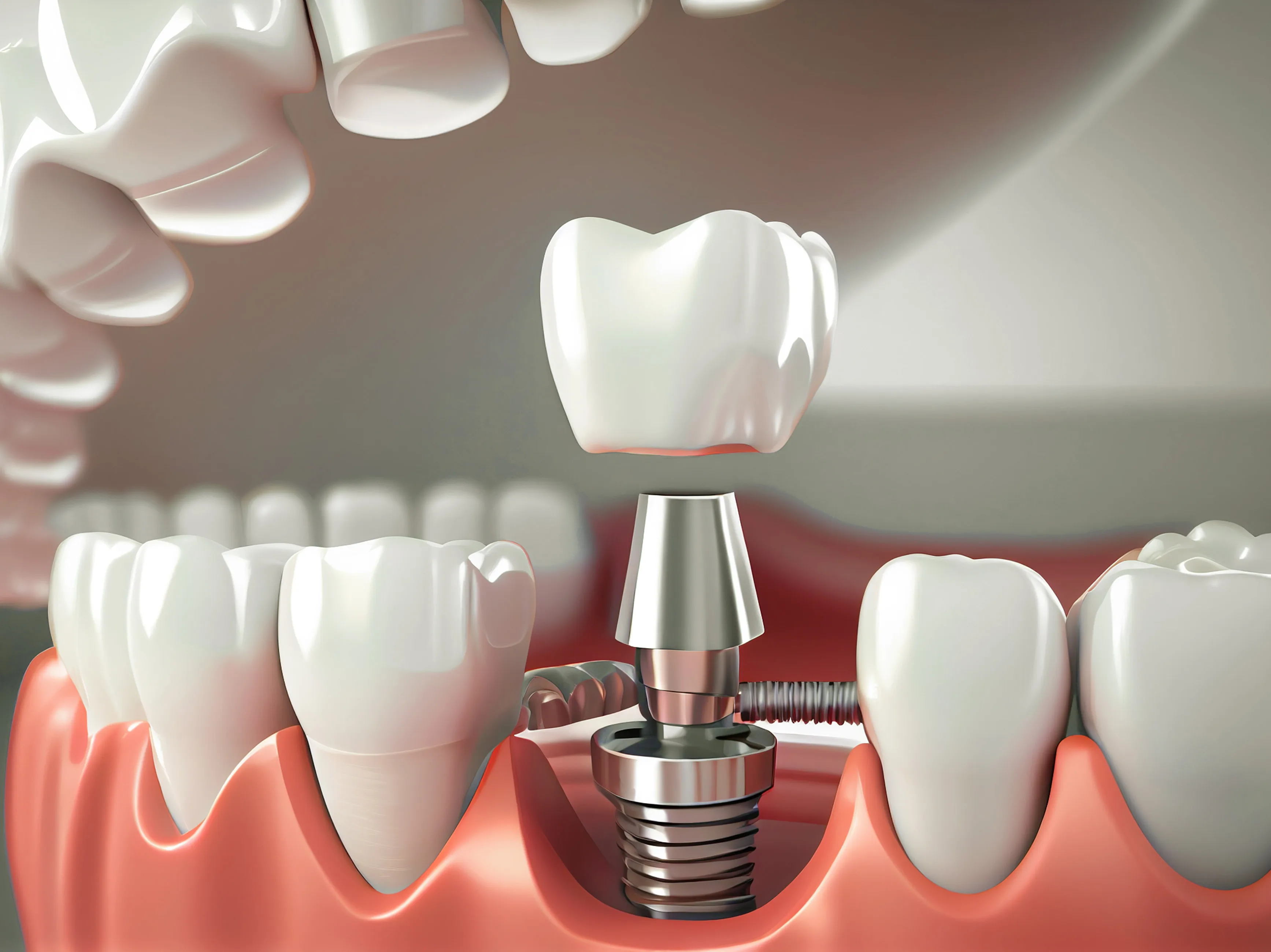 Trồng Răng Implant Đơn Lẻ