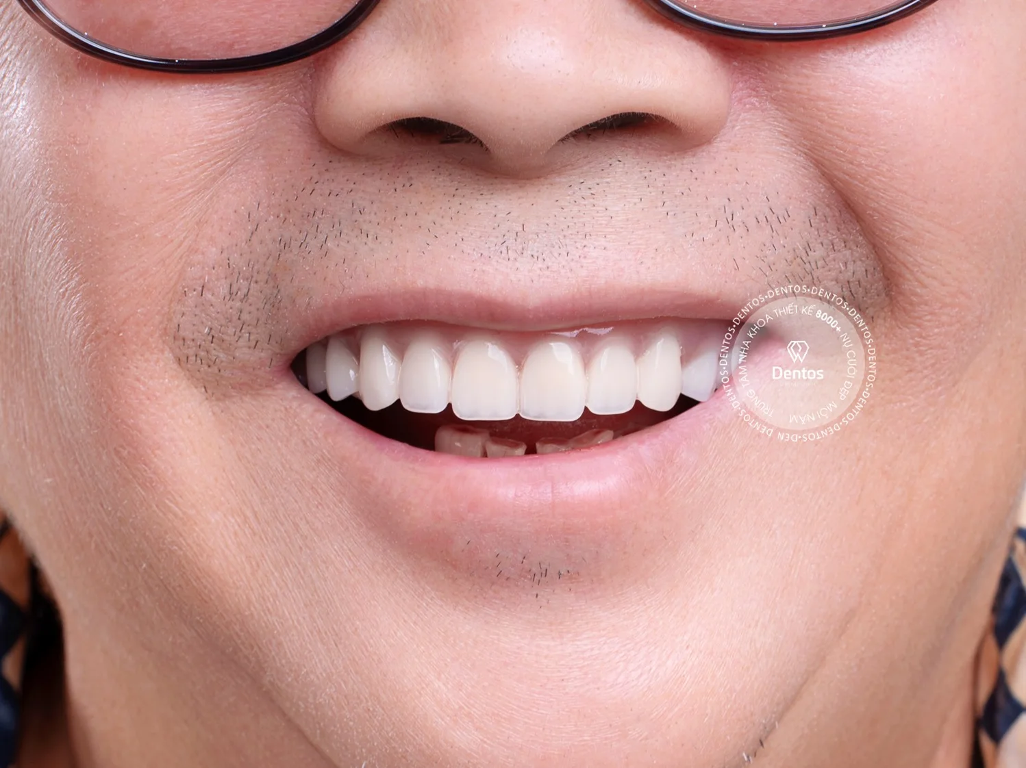 Trồng Răng Implant Straumann Mất Bao Lâu?