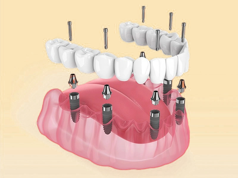 Implant Toàn Hàm All-On-6