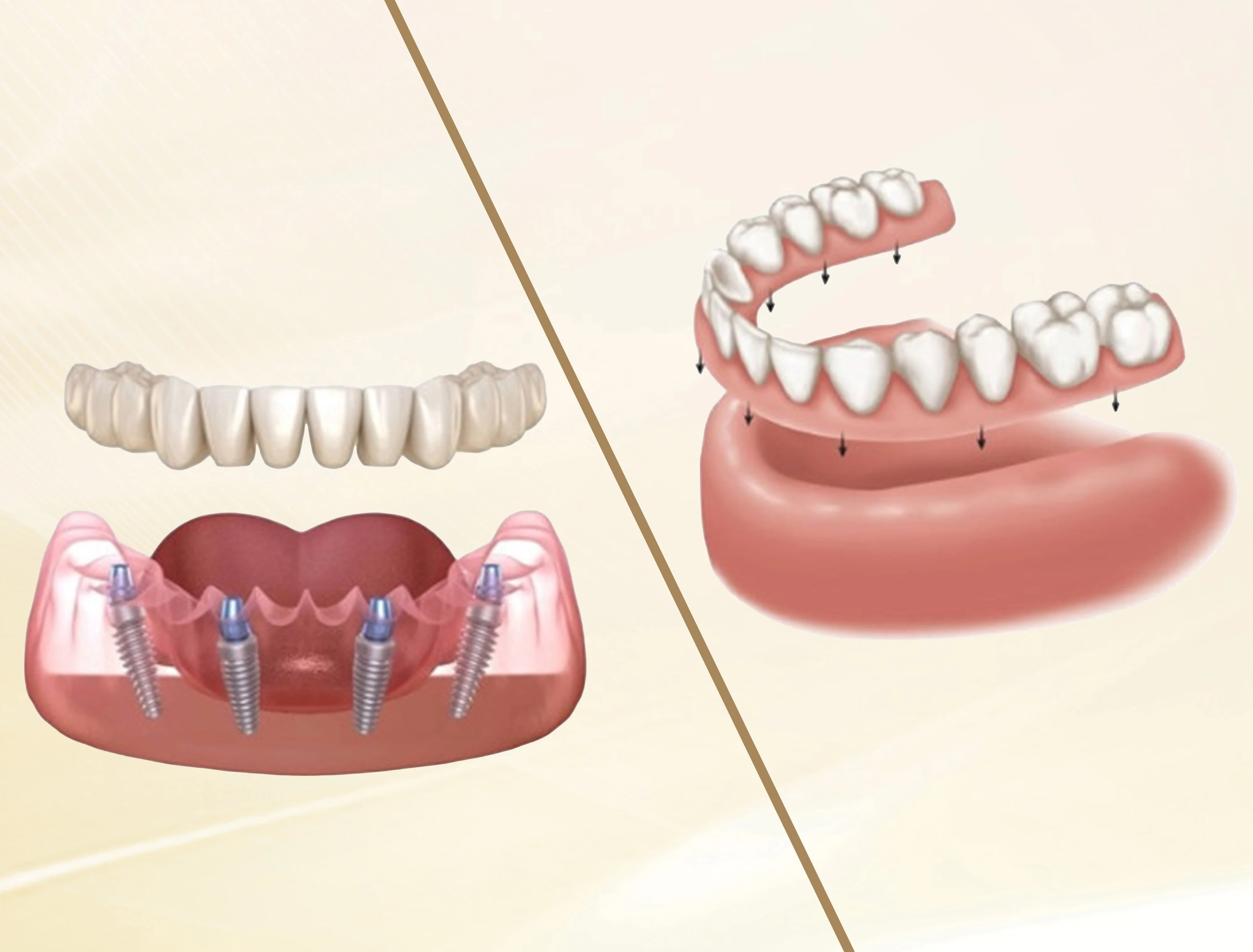 All-on-4 / All-on-6: Kỹ Thuật Y Khoa Đột Phá Cho Người Mất Răng Toàn Hàm 2