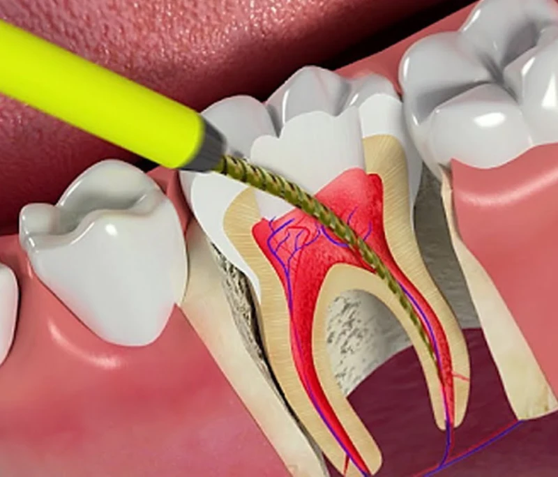 Điều trị tủy răng: Giải pháp cứu răng thật không nên chần chừ