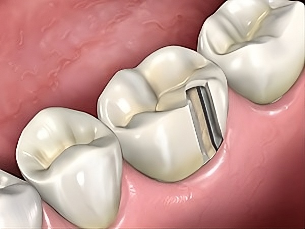 Quy trình tháo răng sứ mất bao lâu? Có bị ê buốt không? Có đau không?