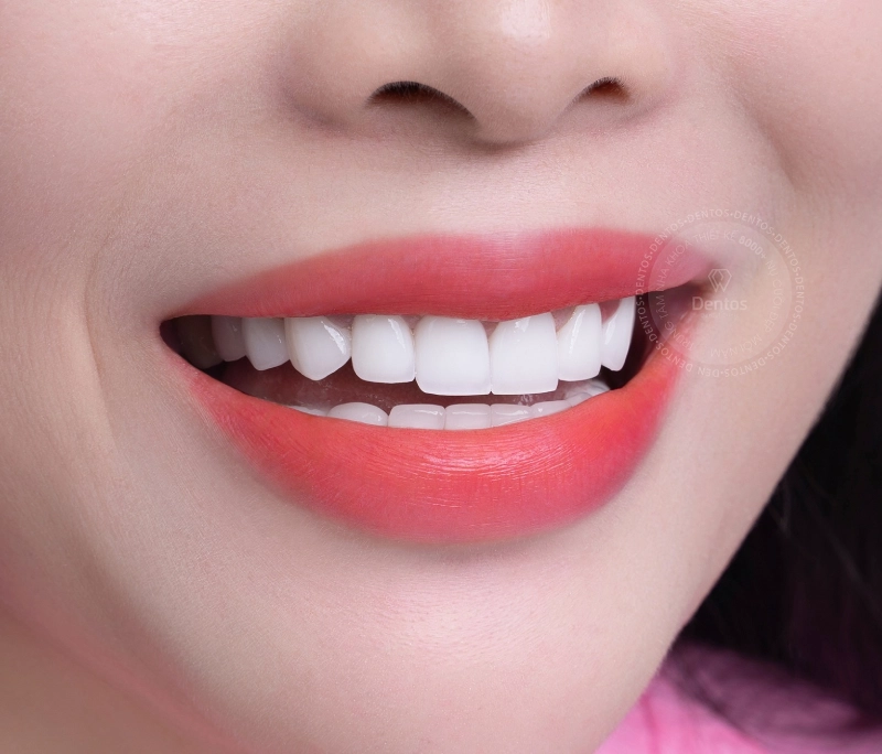 Vì sao bác sĩ luôn ưu tiên răng toàn sứ? Ưu điểm của răng toàn sứ